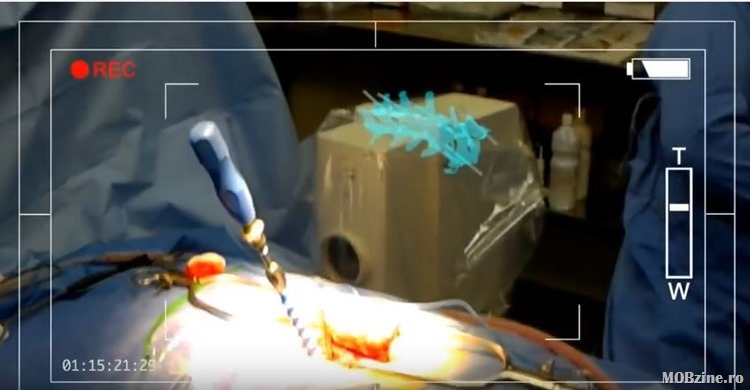 Video: ochelarii HoloLens folositi intr-o operatie pe coloana vertebrala