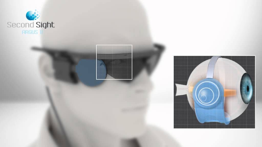 Argus II este un implant de ochi bionic produs de Second Sight Medical Products, ce a rămas fără actualizări software și piese de schimb, lăsând peste 350 de utilizatori în întuneric.